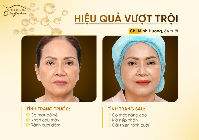 Hiệu quả trẻ hóa vượt trội của sợi chỉ collagen vàng trong công nghệ Mega Fiber Plus