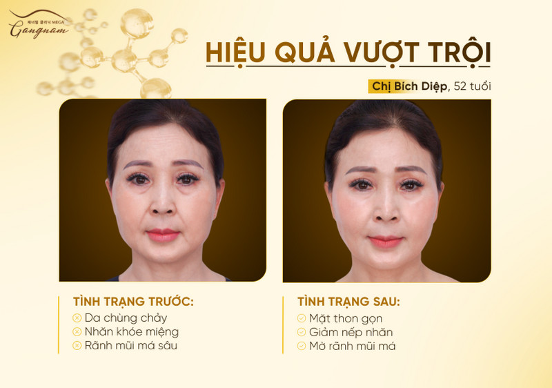 Hiệu quả vượt trội của chị collagen Mega Fiber Plus trên gương mặt chị Bích Diệp