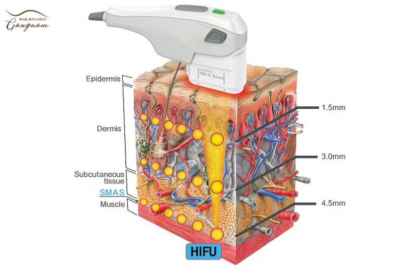 Sóng siêu âm hội tụ cường độ cao của Hifu tác động tới tầng da SMAS
