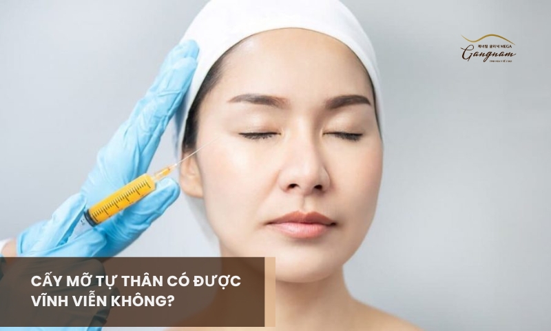 Phương pháp cấy mỡ tự thân có được vĩnh viễn không? Tại sao? 