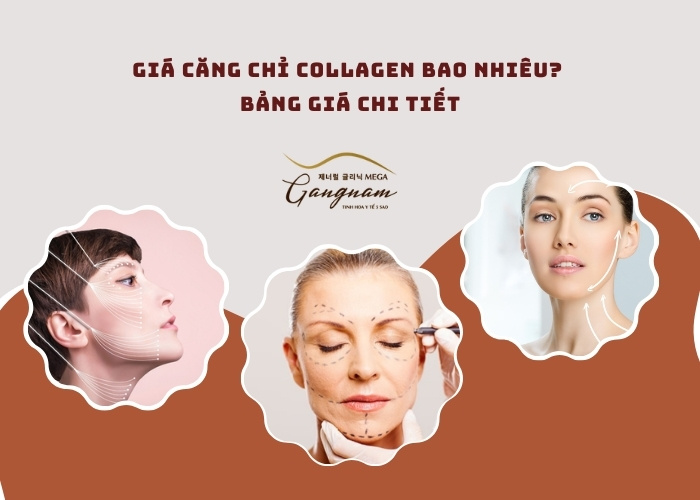 Giá căng chỉ collagen bao nhiêu? Bảng giá chi tiết