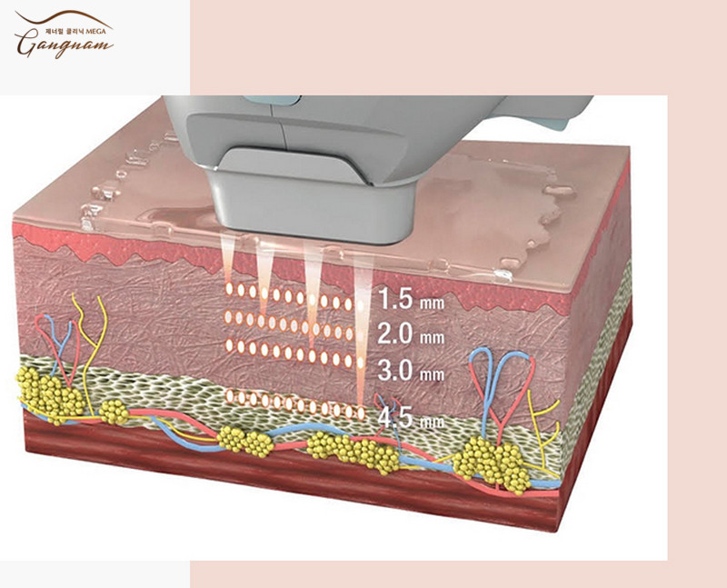 Hifu là công nghệ gì? Hifu Ultrasound hoạt động theo cơ thể sóng siêu âm hội tụ cường độ cao từ 1.5 - 13mm. 