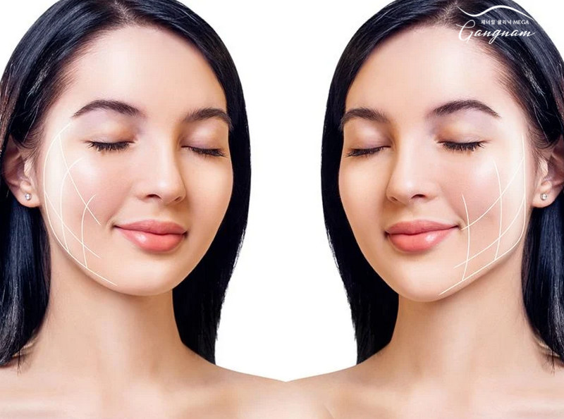 Hifu thấy rõ hiệu quả nhất sau 3 tháng nhờ khả năng tăng sinh collagen tự nhiên