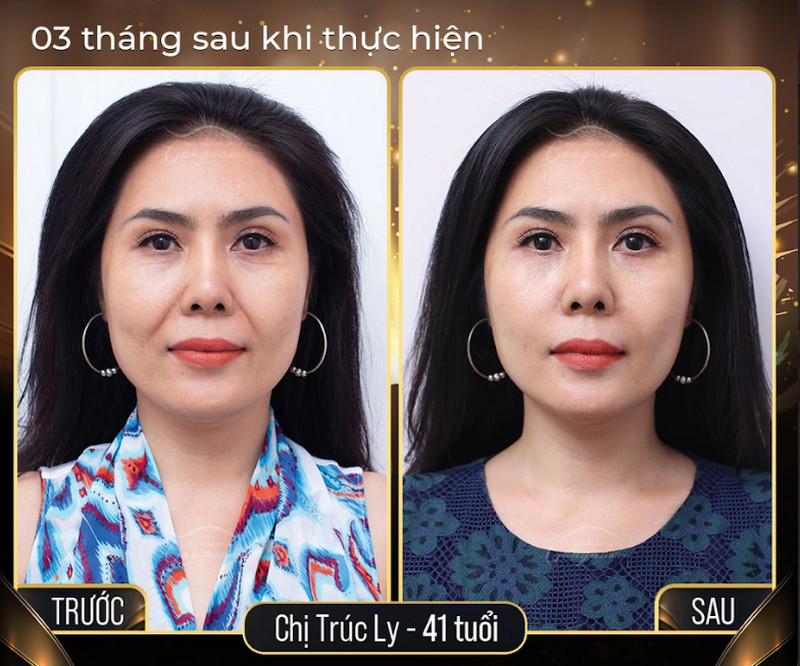 Kết quả sau 3 tháng thực hiện căng chỉ nâng cơ mặt