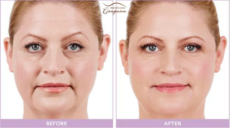 Kết quả tiêm filler làm đầy vùng da rãnh mũi má và xóa nếp nhăn