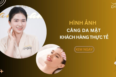 Thực tế hình ảnh căng da mặt từ khách hàng