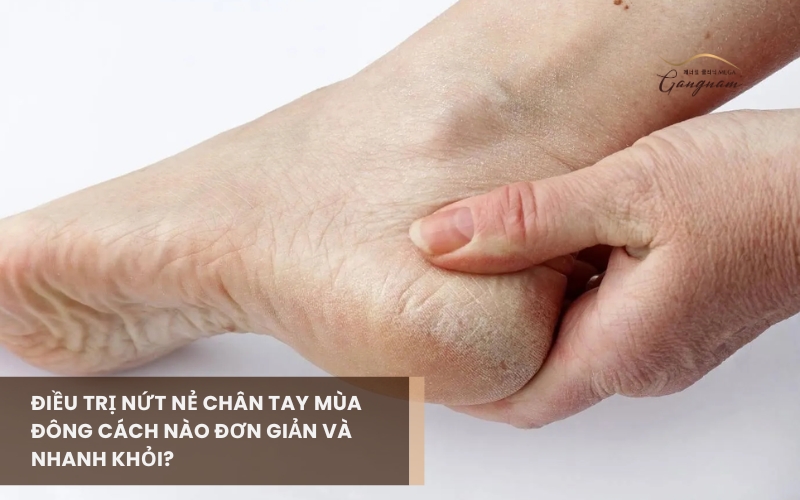 Điều trị nứt nẻ chân tay mùa đông bằng phương pháp nào hiệu quả và nhanh khỏi? 