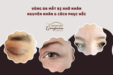 Vùng da mắt bị khô nhăn: Nguyên nhân & Cách phục hồi