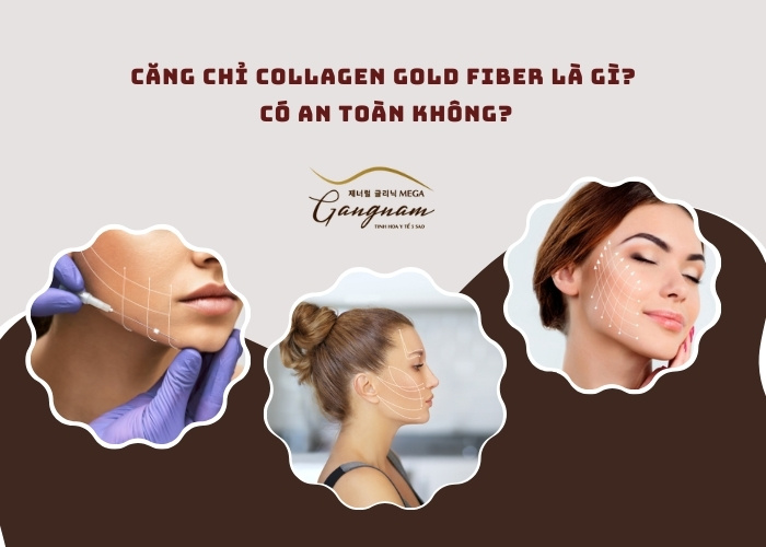 Căng chỉ collagen gold fiber là gì?