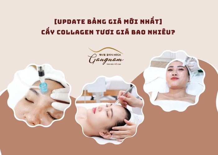 Cấy collagen tươi giá bao nhiêu?