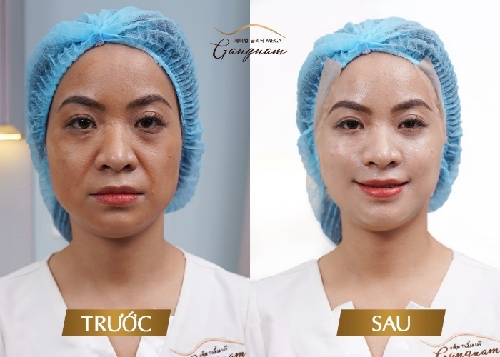 Khách hàng trước và sau khi thực hiện cang chỉ collagen tại Mega Gangnam