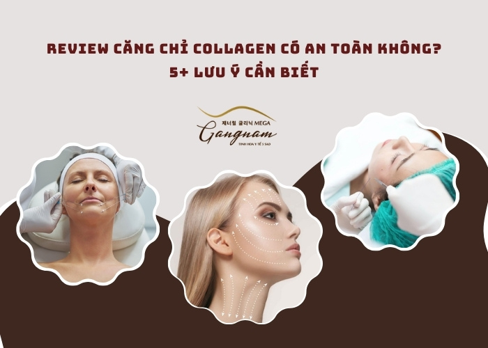 Căng chỉ collagen có an toàn không?