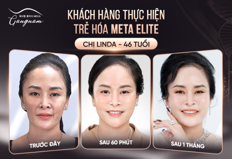 Thay đổi toàn diện của gương mặt khách hàng sau 1 liệu trình trẻ hóa Meta Elite