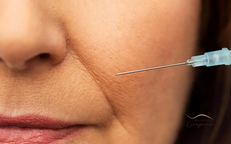 Tiêm rãnh cười giá bao nhiêu tiền? Có gì khác biệt giữa tiêm bằng filler và botox?