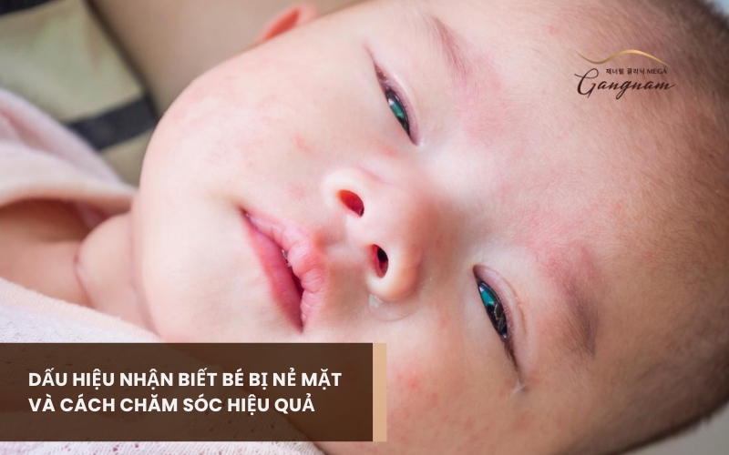 Các dấu hiệu nhận biết bé bị nẻ mặt, nguyên nhân và cách chăm sóc tại nhà 