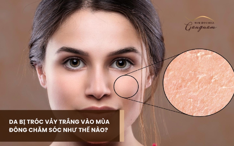 Nguyên nhân khiến da bị tróc vảy trắng vào mùa đông là gì? Chăm sóc như thế nào? 