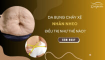 Da bụng nhăn nheo chảy xệ điều trị như thế nào?