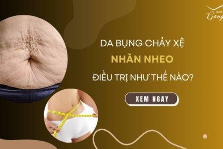 Da bụng nhăn nheo chảy xệ điều trị như thế nào?