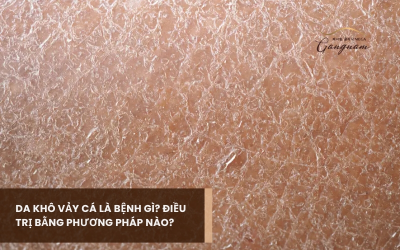 Da khô vảy cá là bệnh gì? Dấu hiệu nhân biết, nguyên nhân và cách điều trị