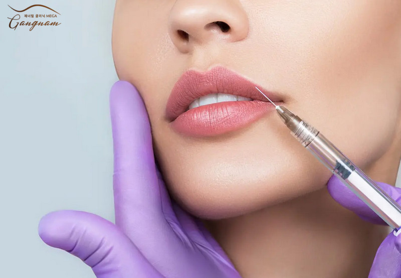 Hiệu quả duy trì độ căng bóng, trẻ hóa của filler Restylane từ 6-12 tháng.