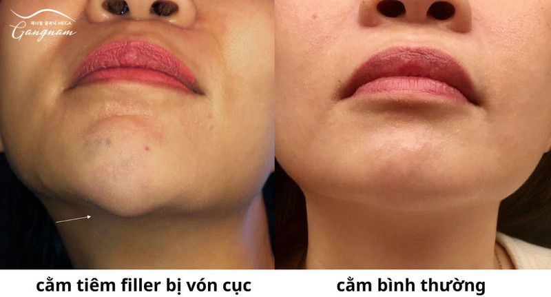 Filler vón cục có thể cần xử lý tức thì để tránh biến chứng nặng về sau