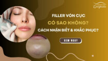 Filler vón cục có sao không? Cách nhận biết và khắc phục