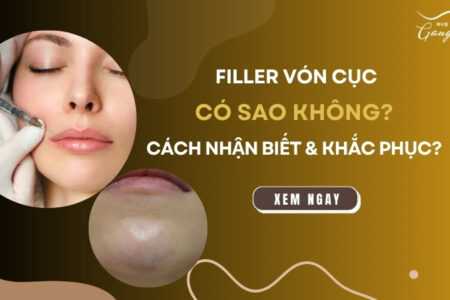 Filler vón cục có sao không? Cách nhận biết và khắc phục