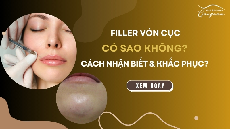 Filler vón cục có sao không? Cách nhận biết và khắc phục