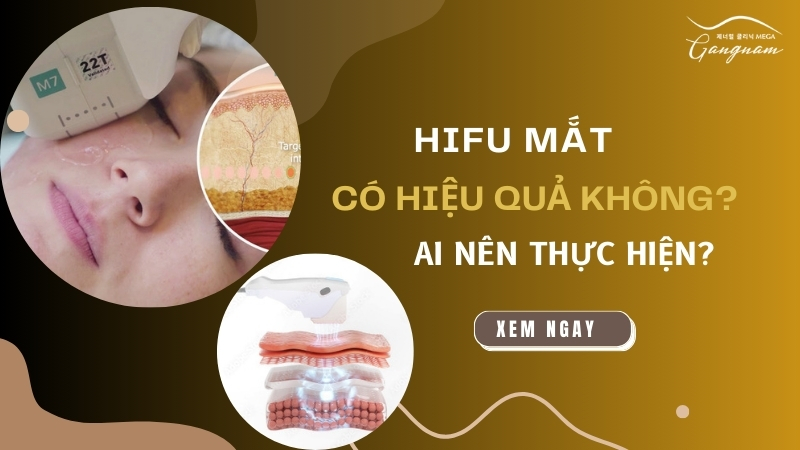 Hifu mắt có hiệu quả không? Ai nên thực hiện?