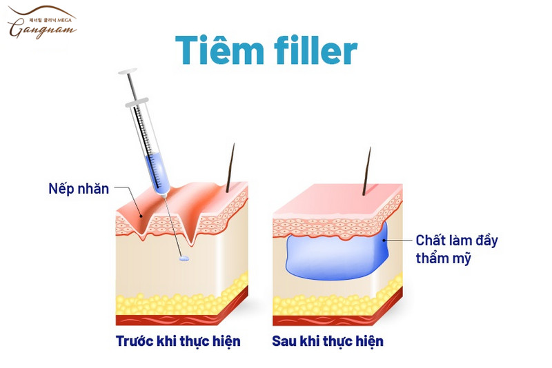 Sau khi đưa kim tiêm vào đúng vị trí cần tiêm, bề mặt da được nâng đỡ là bù đắp thiếu hụt về thể tích cho kết quả da căng hơn. 