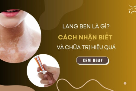 Lang ben là gì? Dấu hiệu nhận biết và cách chữa trị