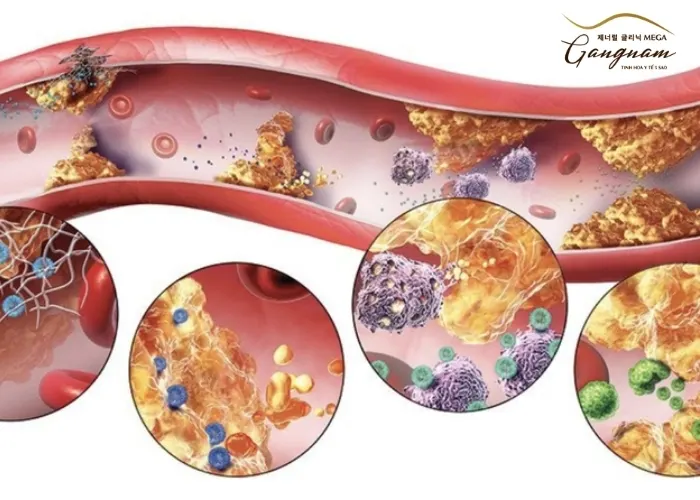 Tiền sử gia đình ảnh hưởng đến LDL Cholesterol