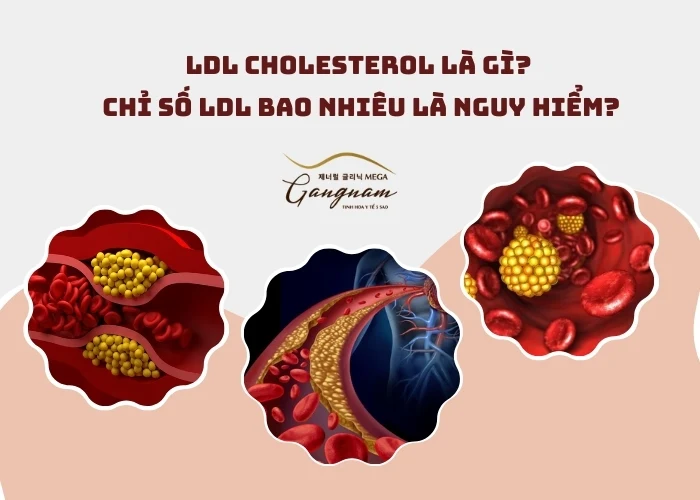 LDL cholesterol là gì?