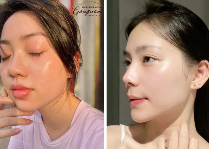 Mát xa mặt nhiều giúp da chống lão hóa, sản xuất collagen 