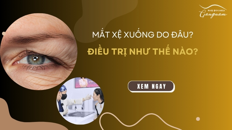 Mắt xệ xuống do đâu? Điều trị như thế nào?