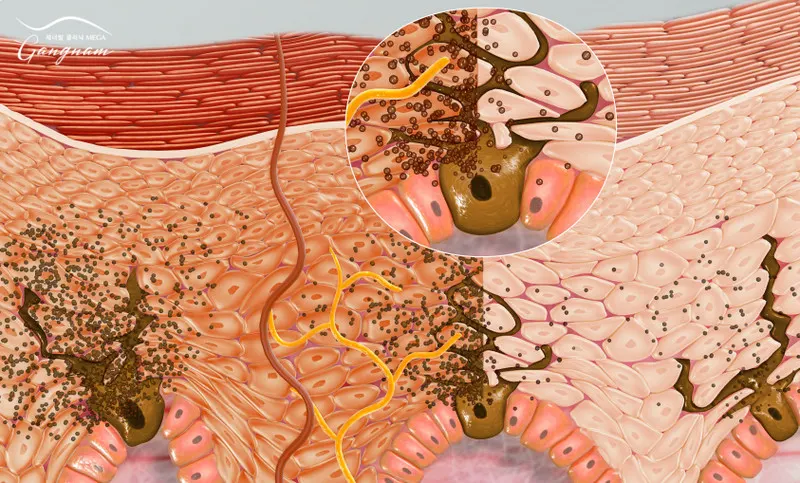 Melanin có thể nằm rải rác ở lớp đáy thượng bì và cũng có thể tập trung tạo thành nám da, tàn nhang