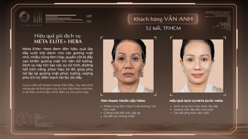 Hình ảnh trước sau khi thực hiện Meta Elite+ khách hàng Vân Anh