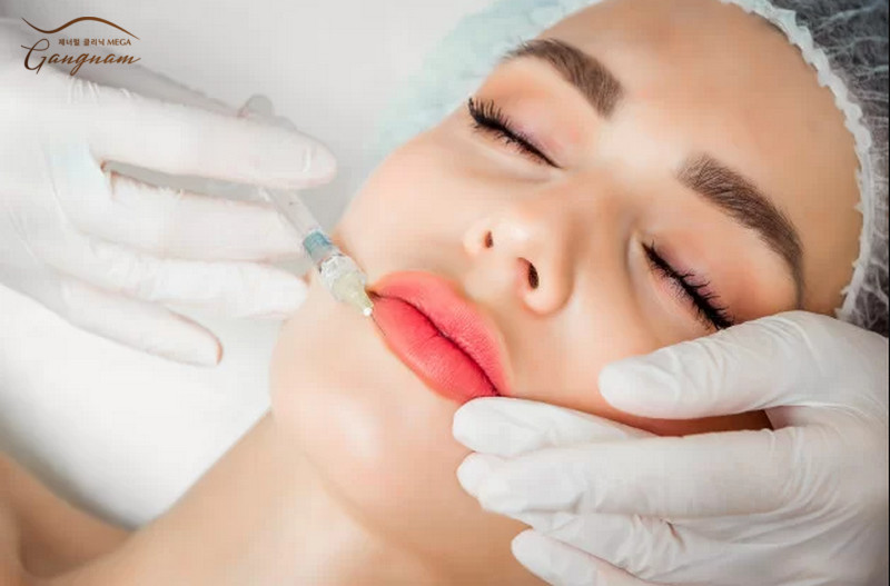 Cách trị môi nhiều nếp nhăn bằng filler