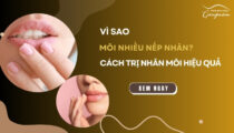 Môi nhiều nếp nhăn vì sao? Cách trị nhăn môi hiệu quả