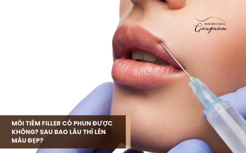 Giải đáp môi tiêm filler có phun được không? Cần chờ đợi bao lâu? 