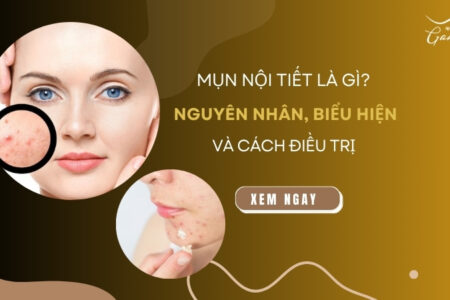 Mụn nội tiết là gì? Nguyên nhân, biểu hiện và cách điều trị