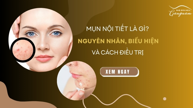 Mụn nội tiết là gì? Nguyên nhân, biểu hiện và cách điều trị 