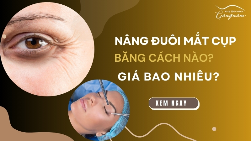 Nâng đuôi mắt cụp bằng cách nào? Giá bao nhiêu tiền