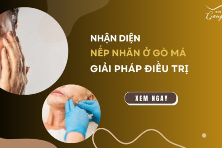 Giải pháp điều trị nếp nhăn ở gò má hiệu quả