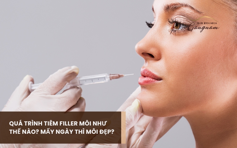 Quá trình tiêm filler môi như thế nào? Cần đảm bảo những tiêu chí gì khi thực hiện?