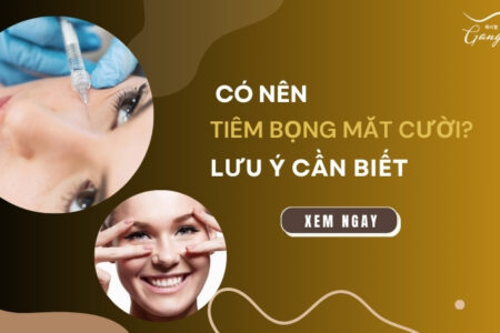 Tiêm bọng mắt cười có nên hay không?