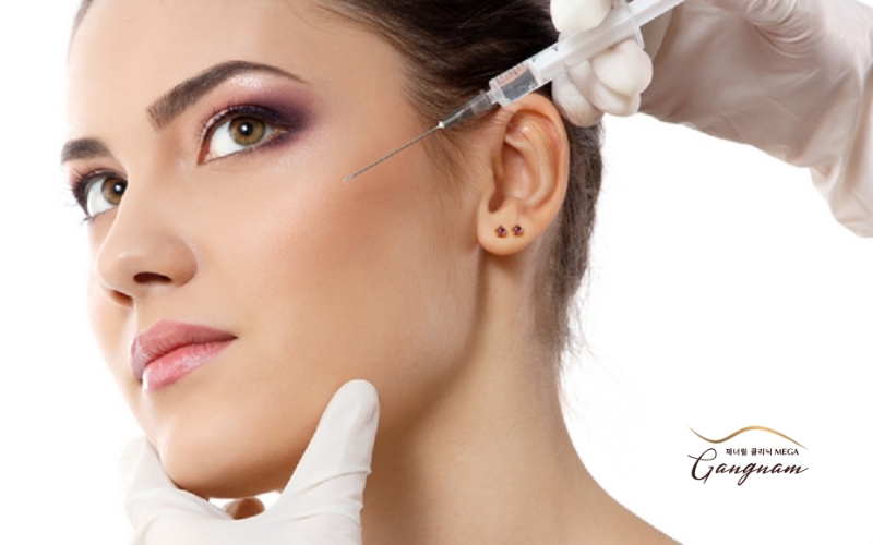 Tiêm thái dương bằng filler giúp lấp đầy các vùng bị hóp, kéo căng da trán, giảm nếp nhăn khóe mắt 