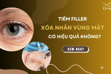 Tiêm filler xóa nhăn mắt có hiệu quả không? 