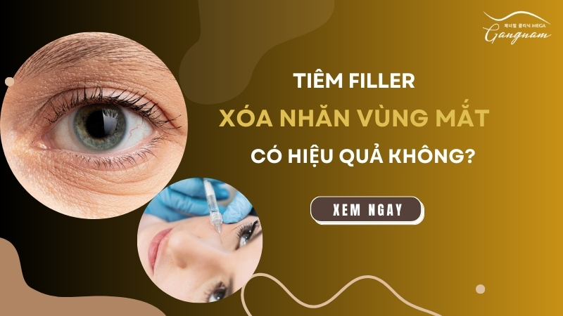 Tiêm filler xóa nhăn mắt có hiệu quả không? 