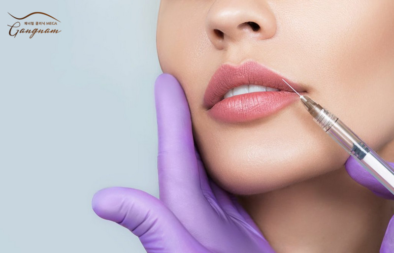 Môi tiêm filler đẹp với dáng cánh én đầy nữ tính 